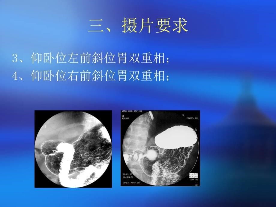 上消化道钡餐造影摄片标准PPT课件_第5页