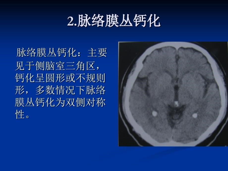 颅内钙化的影像学分析ppt课件_第5页