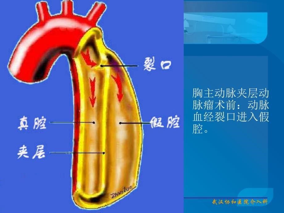 主动脉夹层的介入治疗与护理陈冬萍ppt课件_第5页