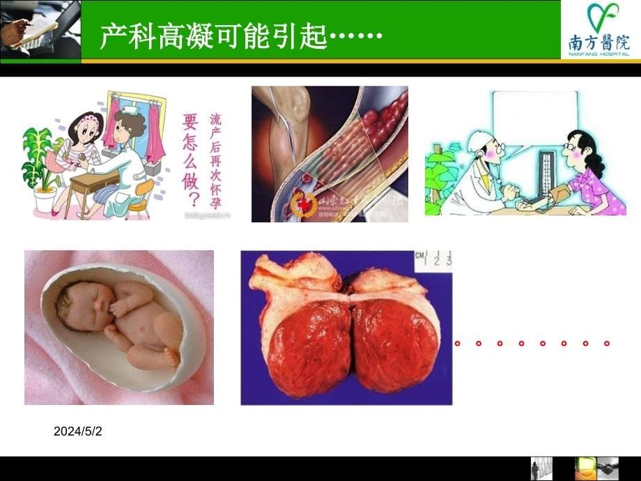 低分子肝素在产科的应用--讲课资料_第5页