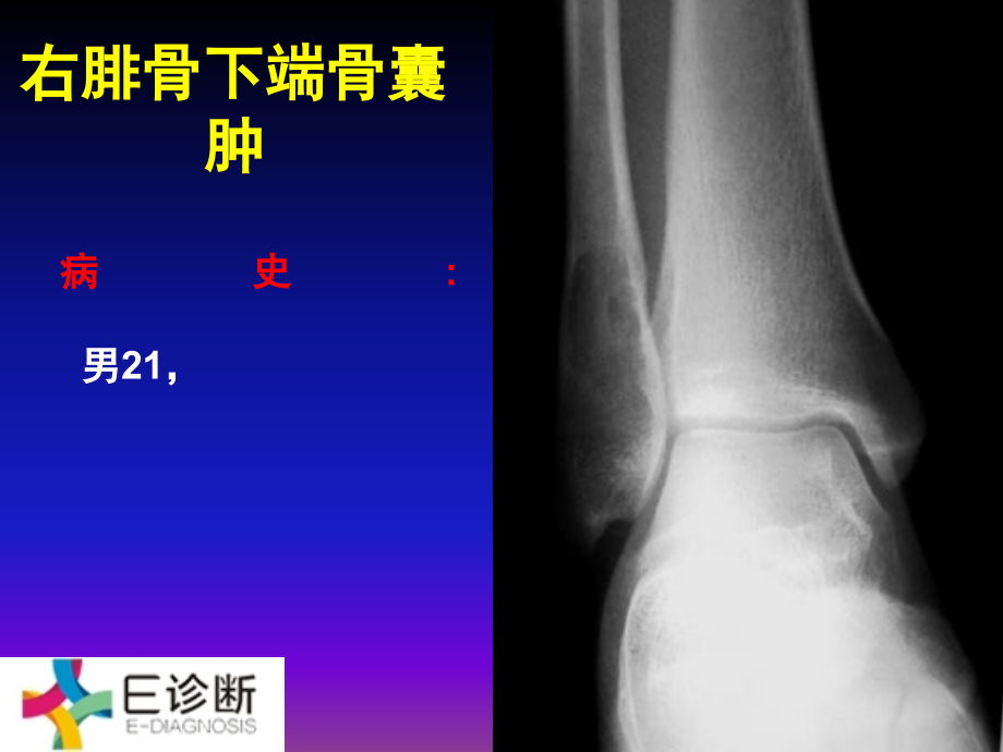 医学影像-骨肿瘤X线病例图谱(详细)ppt课件_第1页