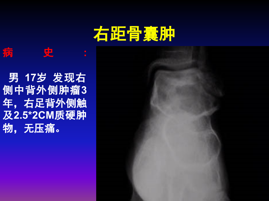 医学影像-骨肿瘤X线病例图谱(详细)ppt课件_第4页