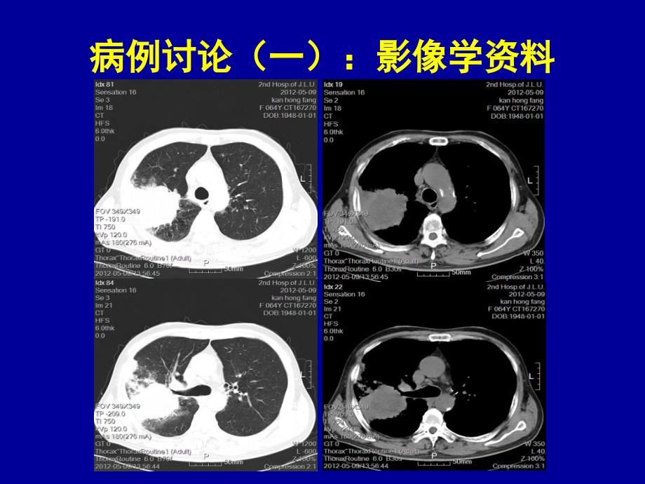 肺癌病例讨论课复习课程_第4页