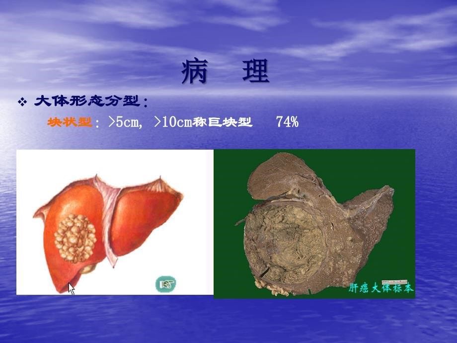 原发性肝癌 (2)ppt课件_第5页