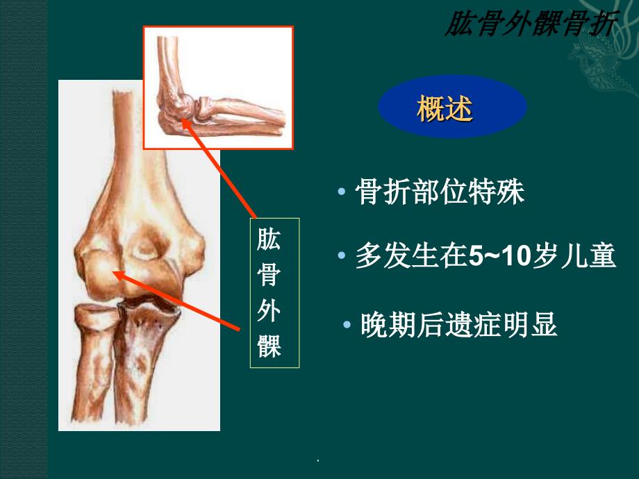 肱骨外髁骨折最新版本_第4页