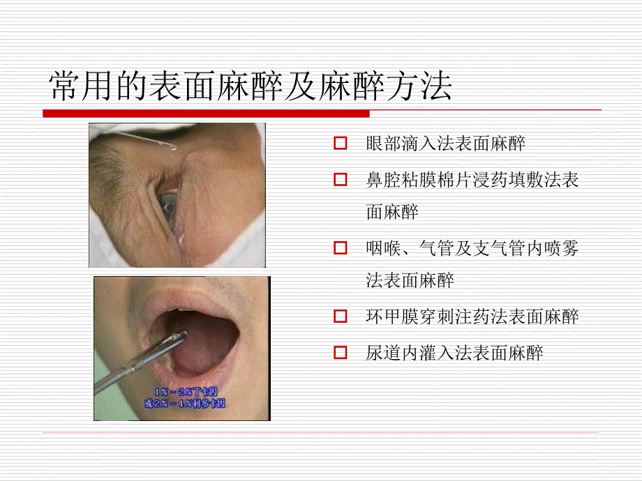 常用局部麻醉方法知识PPT课件_第3页