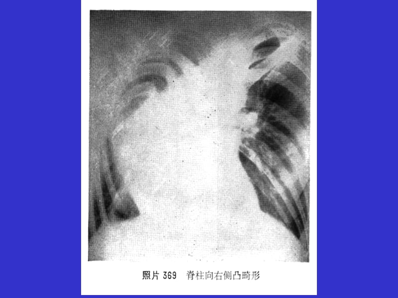 肺原性心脏病知识PPT课件_第5页