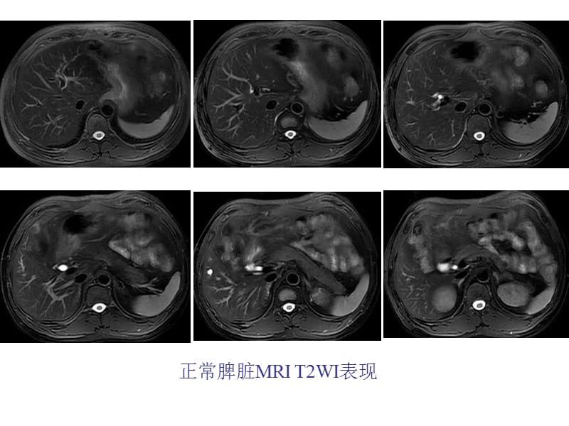 脾脏CT、MRI诊断.ppt_第4页