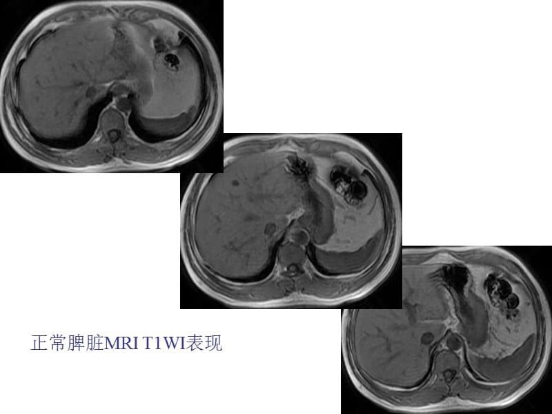 脾脏CT、MRI诊断.ppt_第5页