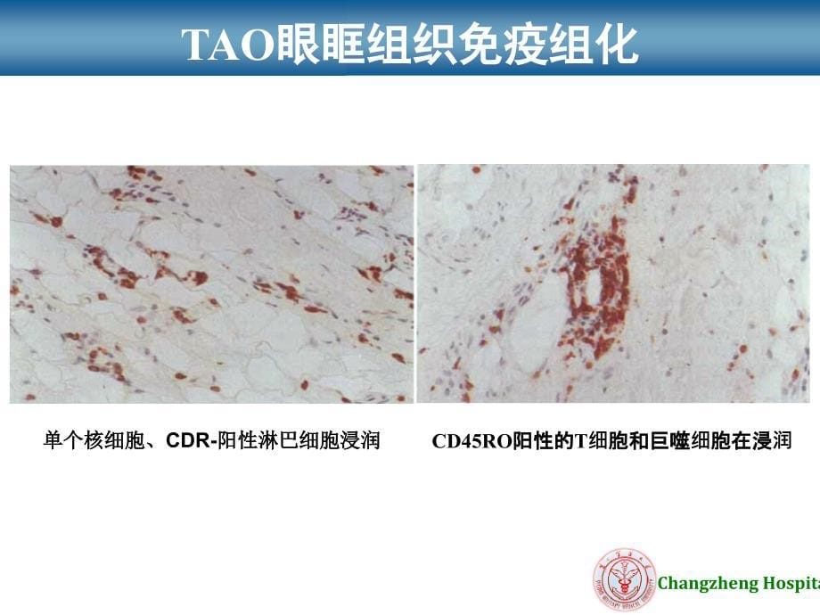 甲状腺相关性眼病新进展最终.ppt_第5页