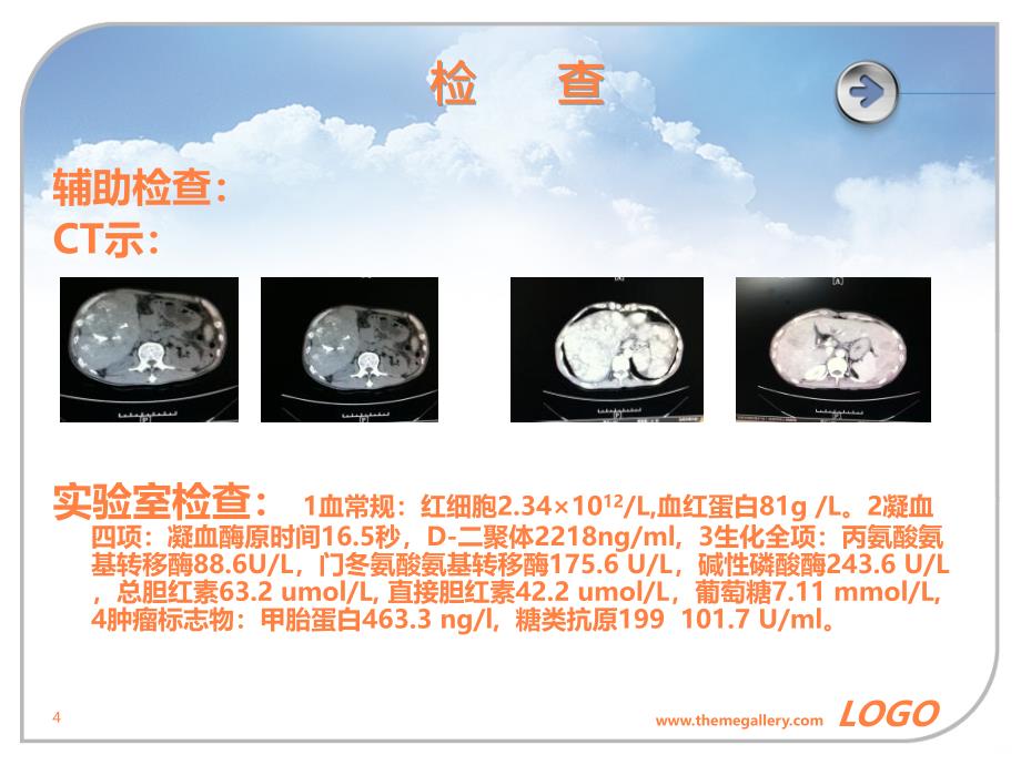 月肝癌护理查房修改后ppt课件_第4页