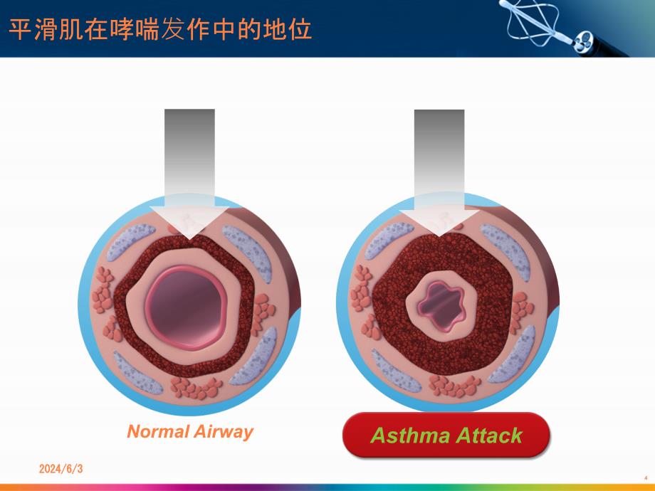 支气管热成型治疗PPT课件_第4页