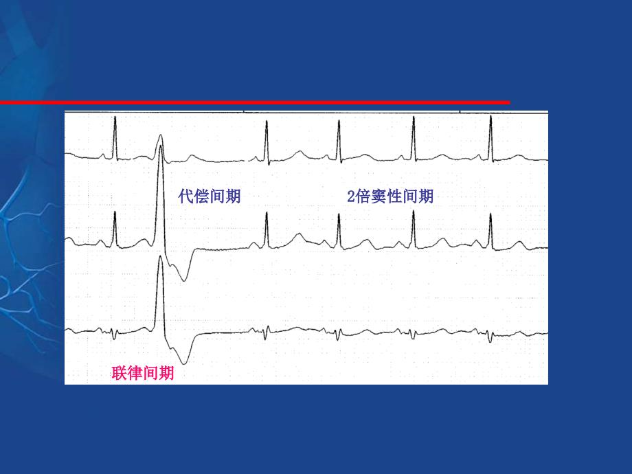 室性早搏的定位诊断与鉴别.ppt_第4页