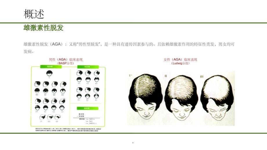 雄激素性脱发非药物治疗Appt课件_第5页