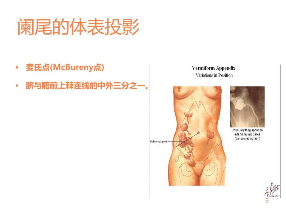 学习课件第三节急性阑尾炎病人的护理ppt课件_第3页