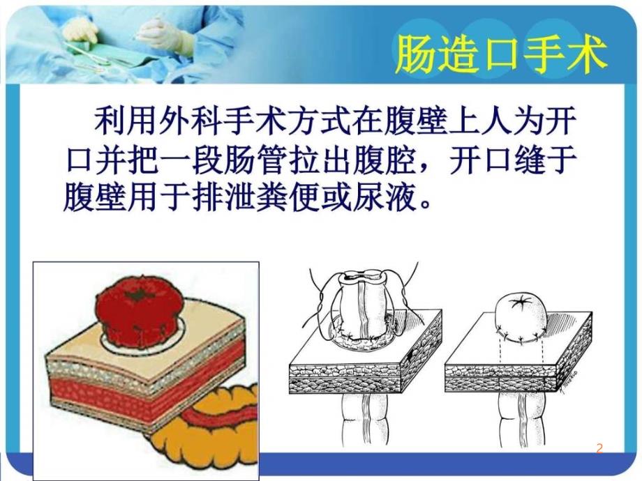 造口术前定位PPT课件_第2页