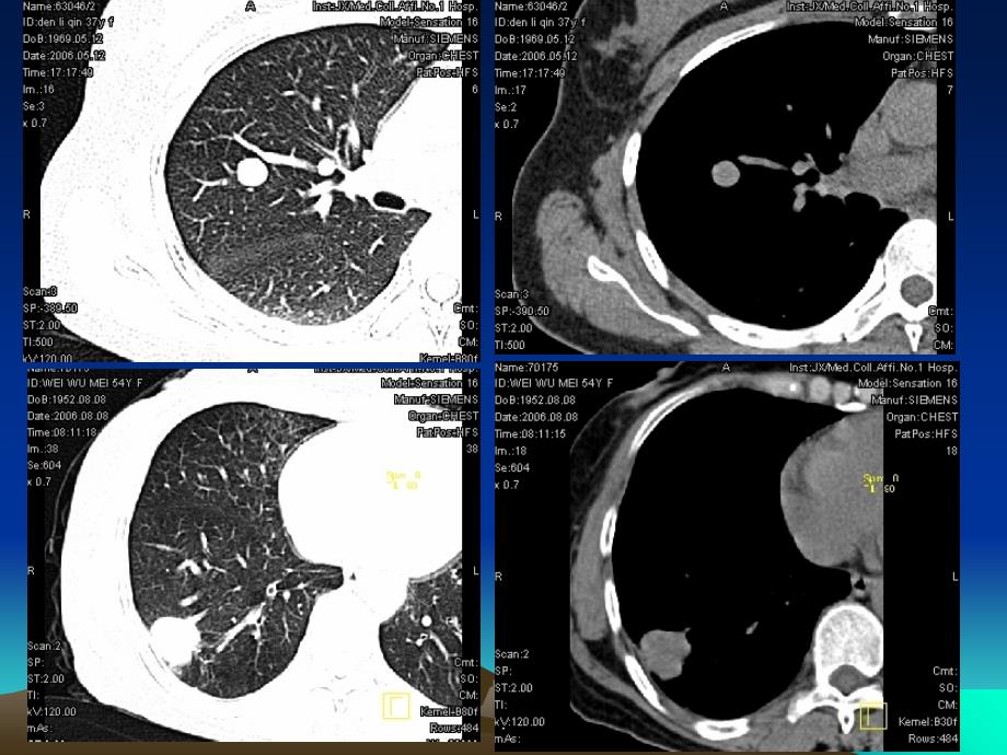 肺结节的CT诊断和鉴别诊断ppt课件_第3页