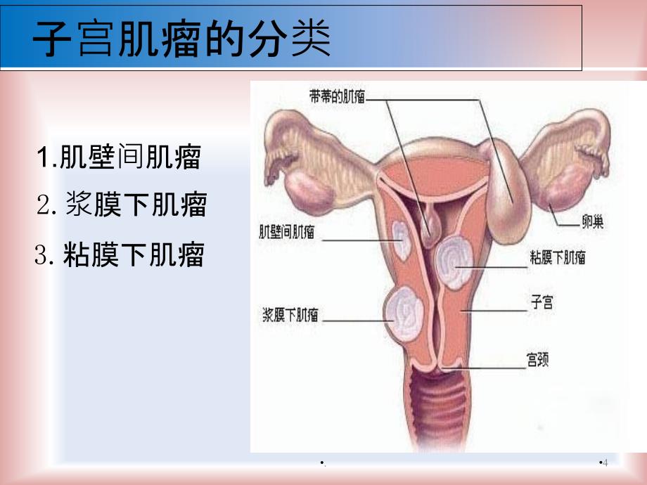 子宫肌瘤健康教育PPT课件_第4页