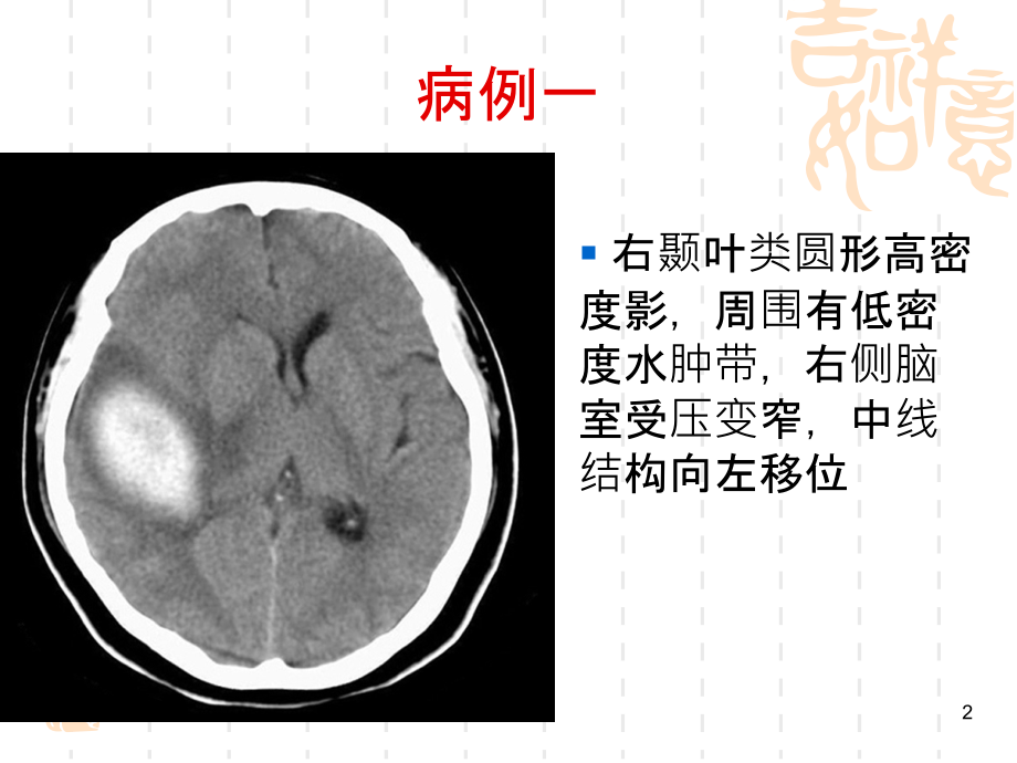 医学影像学病例讲解(MRI、CT、DR)PPT课件_第2页