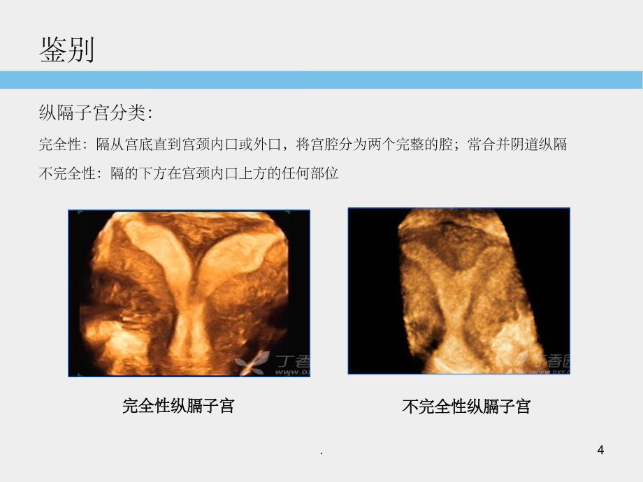 子宫畸形超声诊断标准及思路PPT课件_第4页