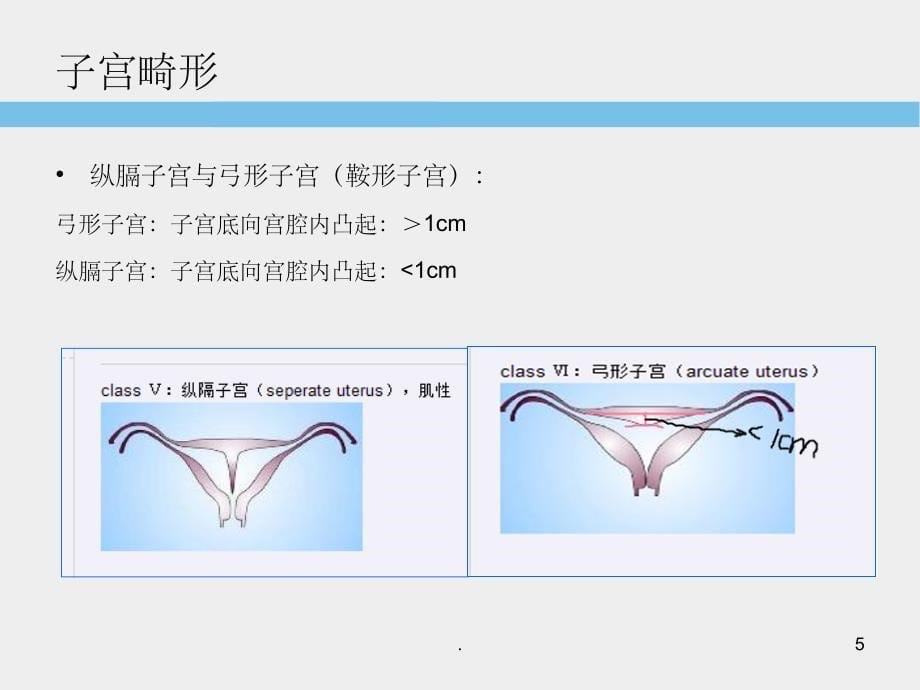 子宫畸形超声诊断标准及思路PPT课件_第5页