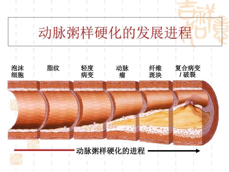 健康教育：冠心病的早期防治教程文件_第5页