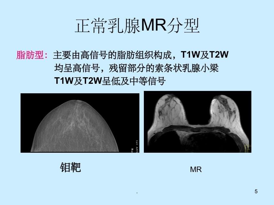 乳腺MRI诊断01092PPT课件_第5页