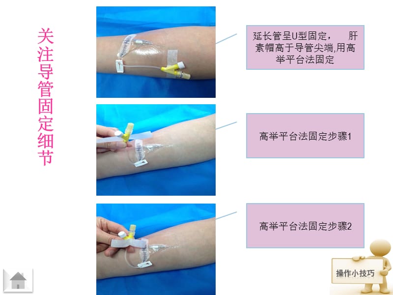 留置针的固定方法_第2页