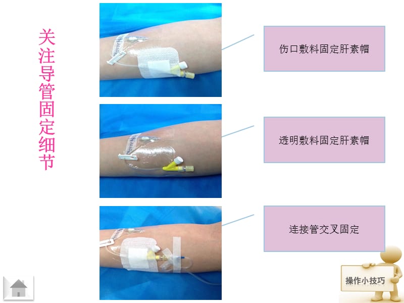 留置针的固定方法_第3页