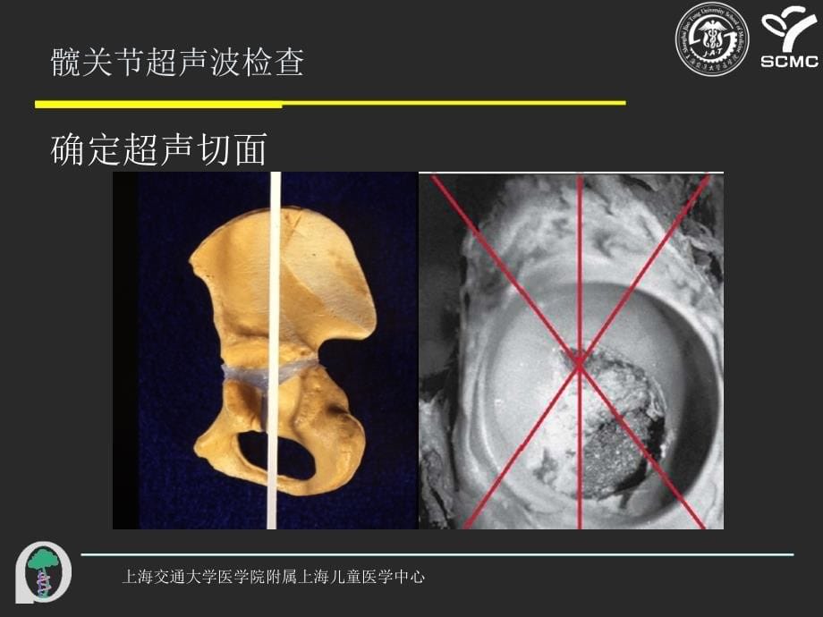 髋关节超声波检查的操作教学提纲_第5页