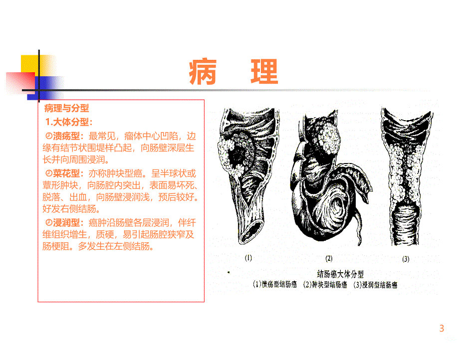 结肠癌根治术ppt课件_第3页