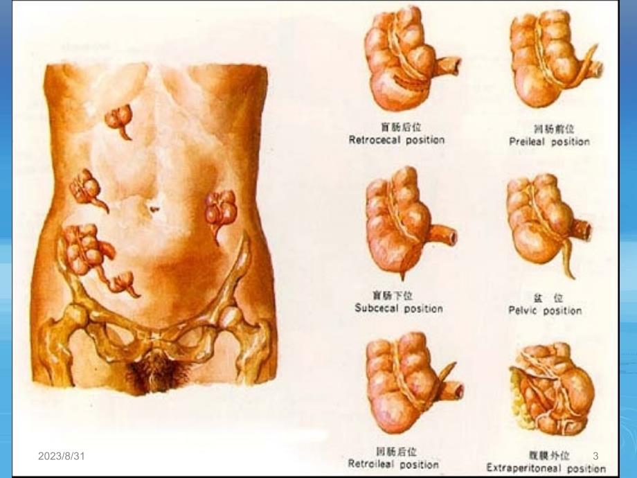 阑尾及阑尾炎ppt课件_第3页