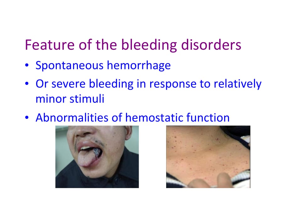 临床医学讲解习题考题bleeding disorders_第2页