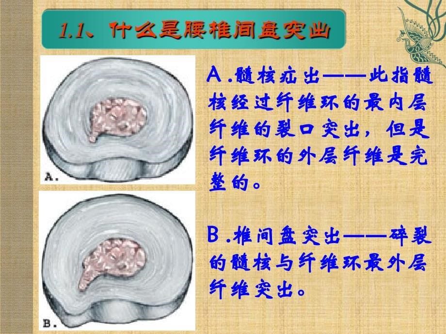 腰椎间盘突出症-终结版_第5页