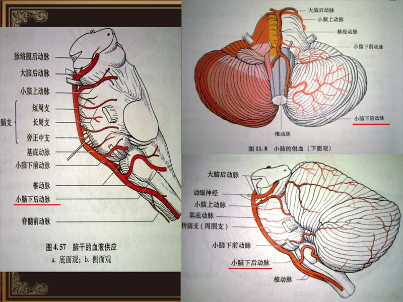 脑血管解剖及脑梗塞定位诊断-小脑后下动脉培训资料_第5页