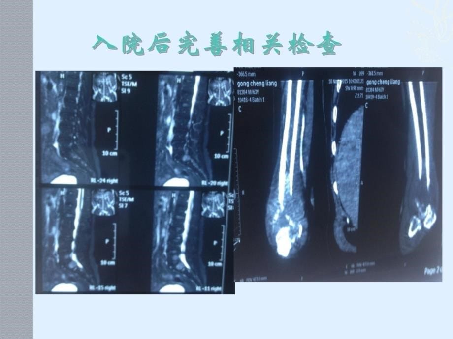 奥施康定止痛病例分享-李为之知识课件_第5页