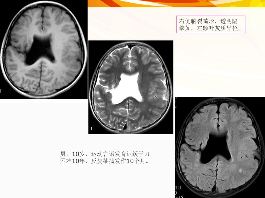 医学影像癫痫的MRI及MRSppt课件_第3页