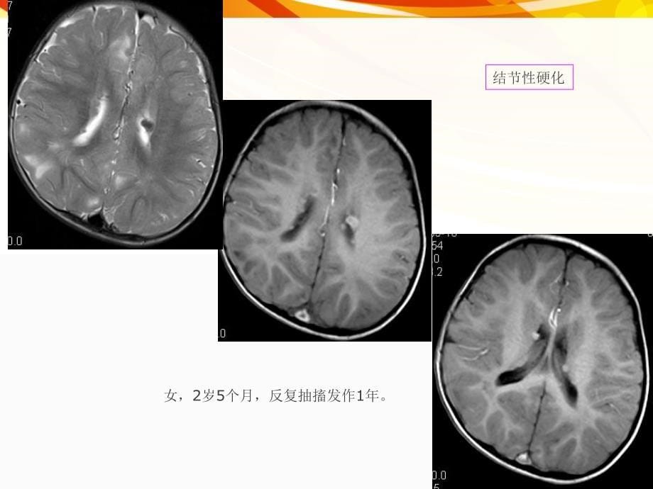 医学影像癫痫的MRI及MRSppt课件_第5页