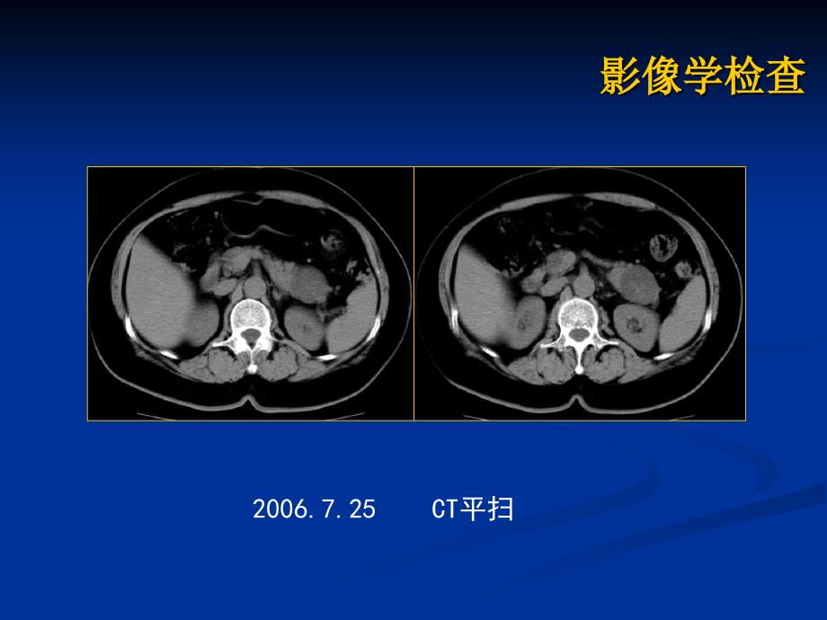 胰腺粘液性囊腺瘤病历讨论教学教材_第4页