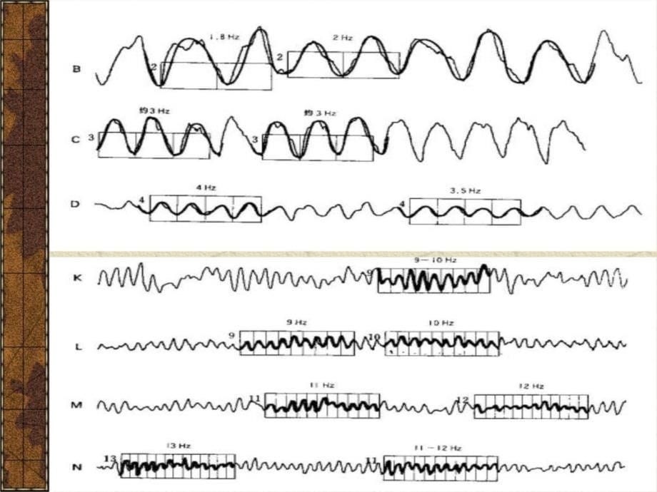 脑电图的临床应用知识分享_第5页
