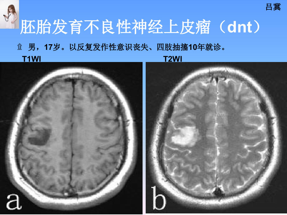 医影在线--CNS疾病影像图库(2)讲解材料_第2页