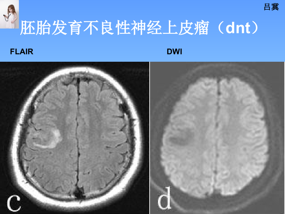 医影在线--CNS疾病影像图库(2)讲解材料_第3页