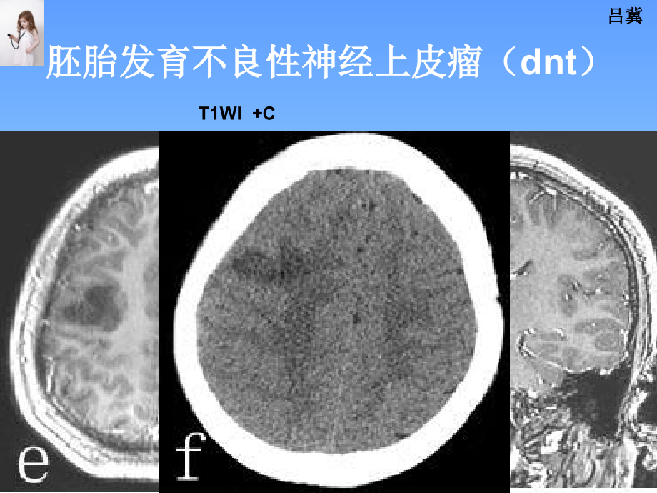 医影在线--CNS疾病影像图库(2)讲解材料_第4页