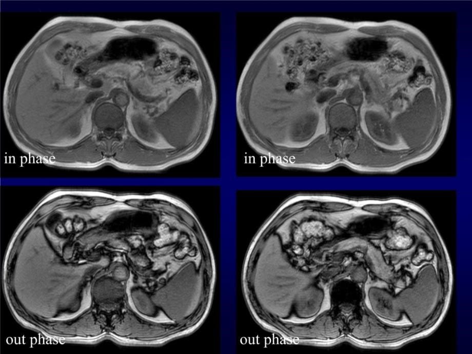内分泌系统疾病的MRI诊断讲义教材_第5页