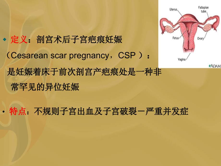 剖宫产术后瘢痕妊娠1知识分享_第2页