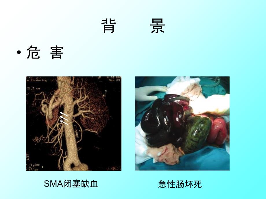 自发孤立型肠系膜上动脉夹层影像学特征在治疗策略中的价值课件讲解材料_第3页