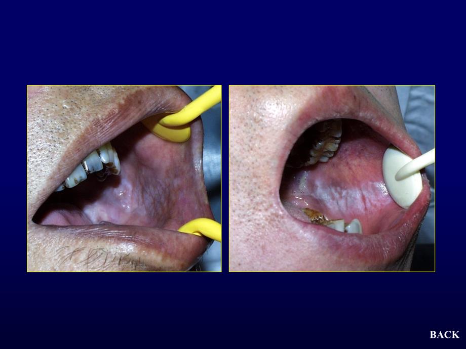 口腔黏膜病(斑纹类)教学材料_第4页
