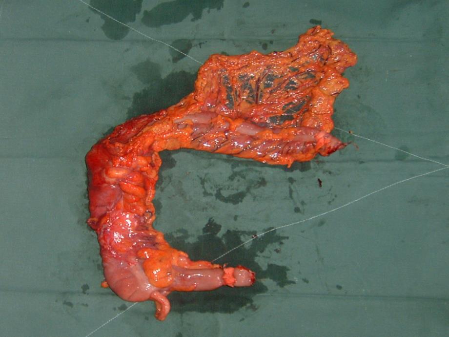 外科医学教研室胃肠外科课件：急性阑尾炎的诊治知识课件_第3页