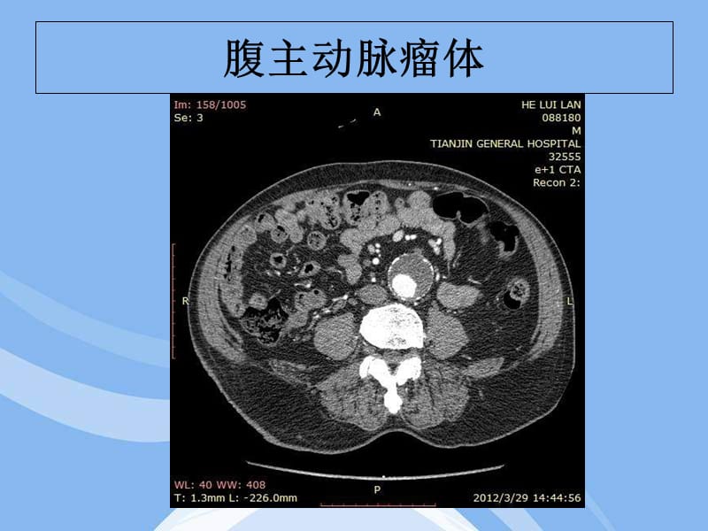 输入道闭塞扭曲腹主动脉瘤合并髂动脉多发动脉瘤一例教程教案_第2页