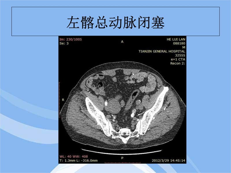 输入道闭塞扭曲腹主动脉瘤合并髂动脉多发动脉瘤一例教程教案_第5页